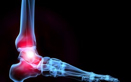 Chronic Ankle Pain in an 11 Year Old Dancer