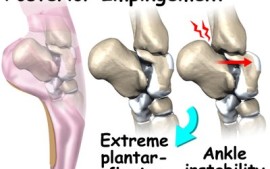 Pain In The Back of The Ankle