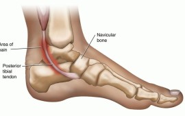 Pain At The Back Of The Ankle – Posterior Impingement?