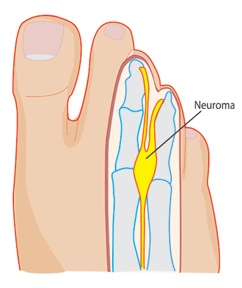 Mortons Neuroma - Anatomy Diagram - Lisa Howell - The Ballet Blog