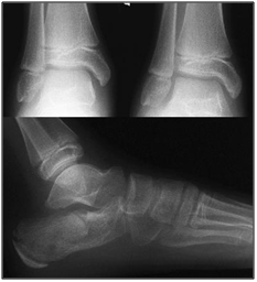 leg, ankle and foot x-ray - - Foot/Ankle X-Ray - Lisa Howell - The Ballet Blog