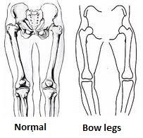 Normal vs Bow legs - Bow Legs in Dancers - Anatomy Diagram - Lisa Howell - The Ballet Blog