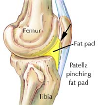 Fat Pad Impingement - Anatomy Diagram - Lisa Howell - The Ballet Blog