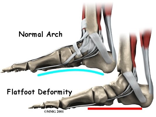Flat Feet vs Normal Arch - Anatomy Diagram - Lisa Howell - The Ballet Blog