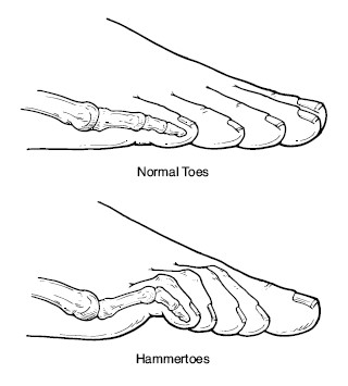 Hammer Toes vs Normal Toes - Anatomy Diagram - Lisa Howell - The Ballet Blog
