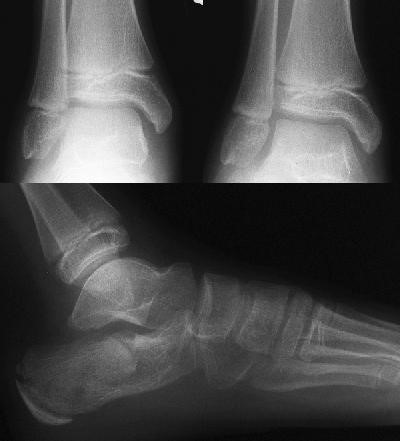 - Foot/Ankle X-Ray - Lisa Howell - The Ballet Blog