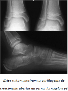 Devo Fazer Um Raio X Antes De Iniciar O Trabalho De Pontas Should I Get An X Ray Before Starting Pointe The Ballet Blog