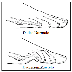 Portuguese Article Image - How Can You Avoid Foot Injuries En Pointe