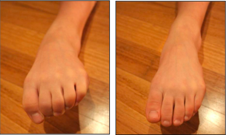 Why Do Dancer's Get Blisters on Their Toes - Portuguese - Article Image
