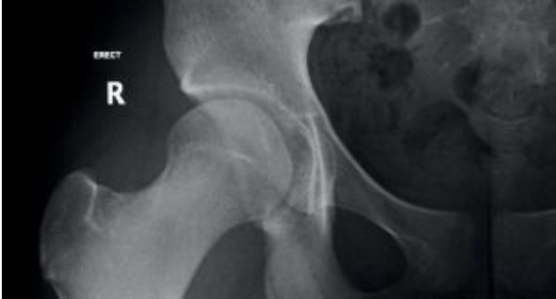 Hip x-ray case study age 14 - Anatomy X-ray - Lisa Howell - The Ballet Blog