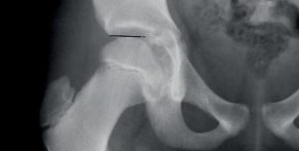 Hip x-ray case study age 13 - Hip X-Ray - Lisa Howell - The Ballet Blog